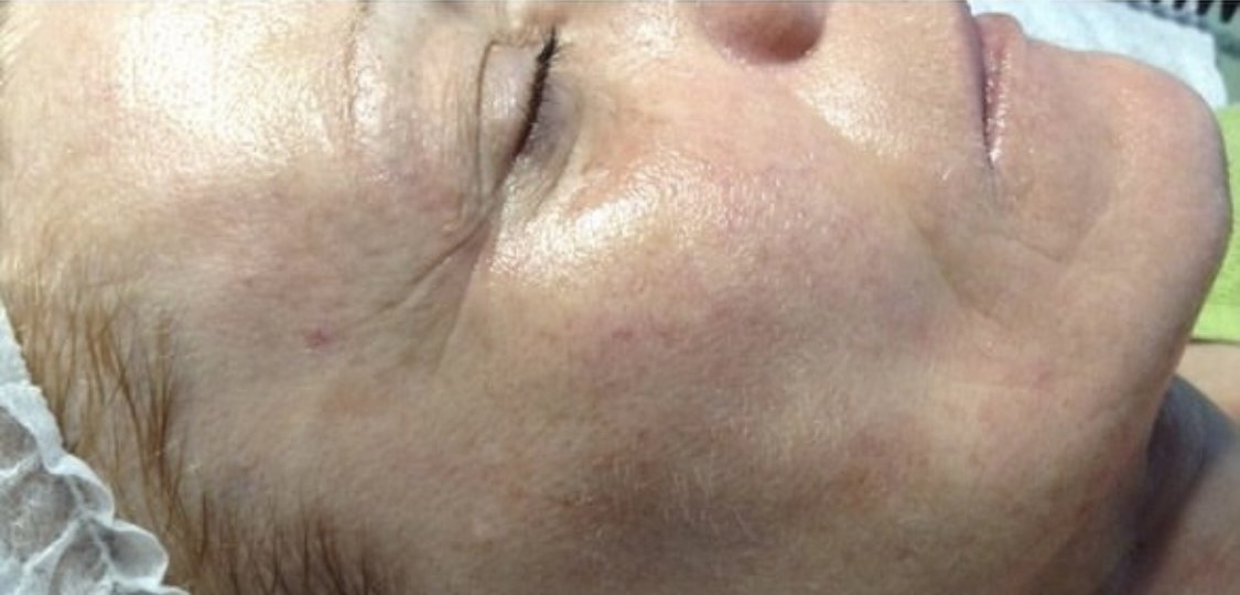 Nachher: dieselbe Gesichtspartie nach der Pora-Pur-Behandlung