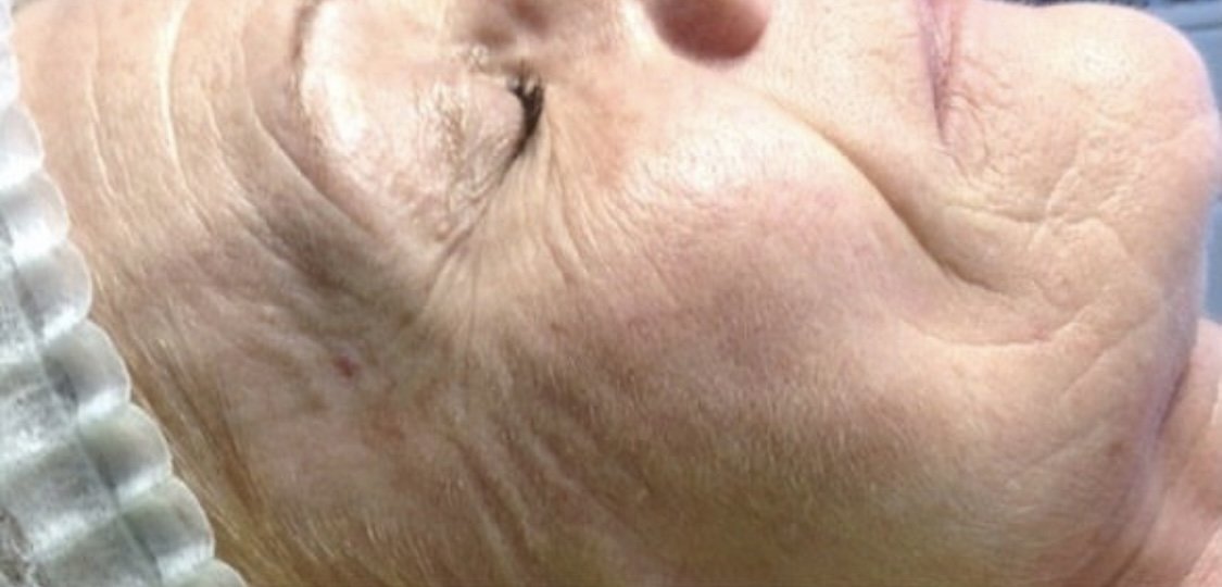 Vorher: Gesichtshaut seitlich an Augen- und Wangenpartie vor der Pora-Pur-Behandlung